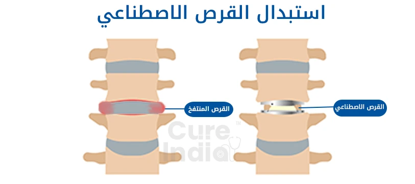 جراحة القرص الاصطناعي